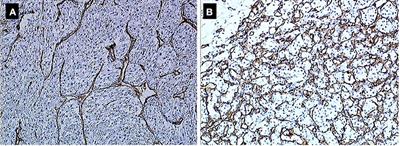 Exploring Biological Predictive Factors of Progression After Surgery in High-Risk Renal Cell Carcinoma: Results From the French Cohort of the Randomized S-TRAC Trial Patients